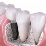 Zobni implantati so primerni za vse starostne skupine